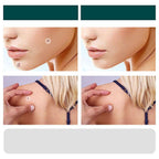 Maqiato | Skin Tag & Wart Removal Patches