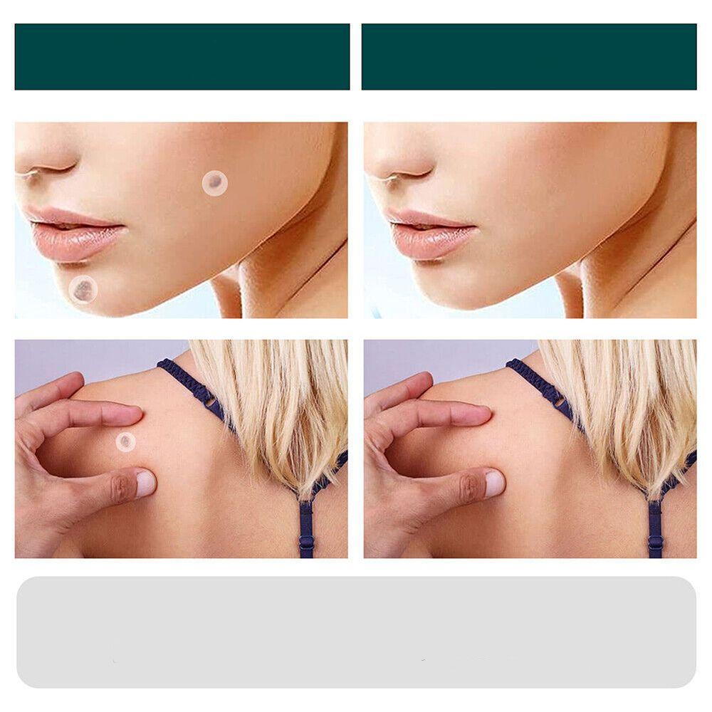Maqiato | Skin Tag & Wart Removal Patches