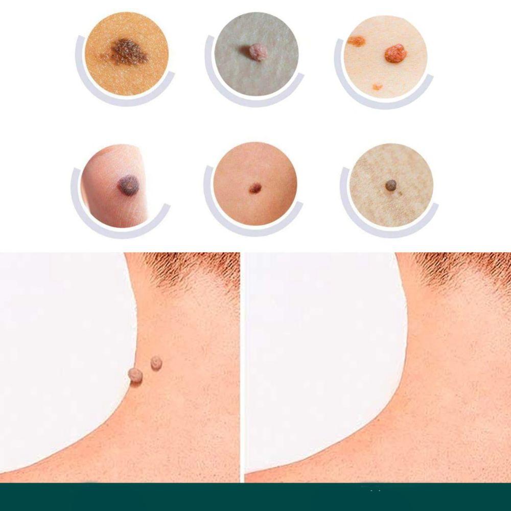 Maqiato | Skin Tag & Wart Removal Patches